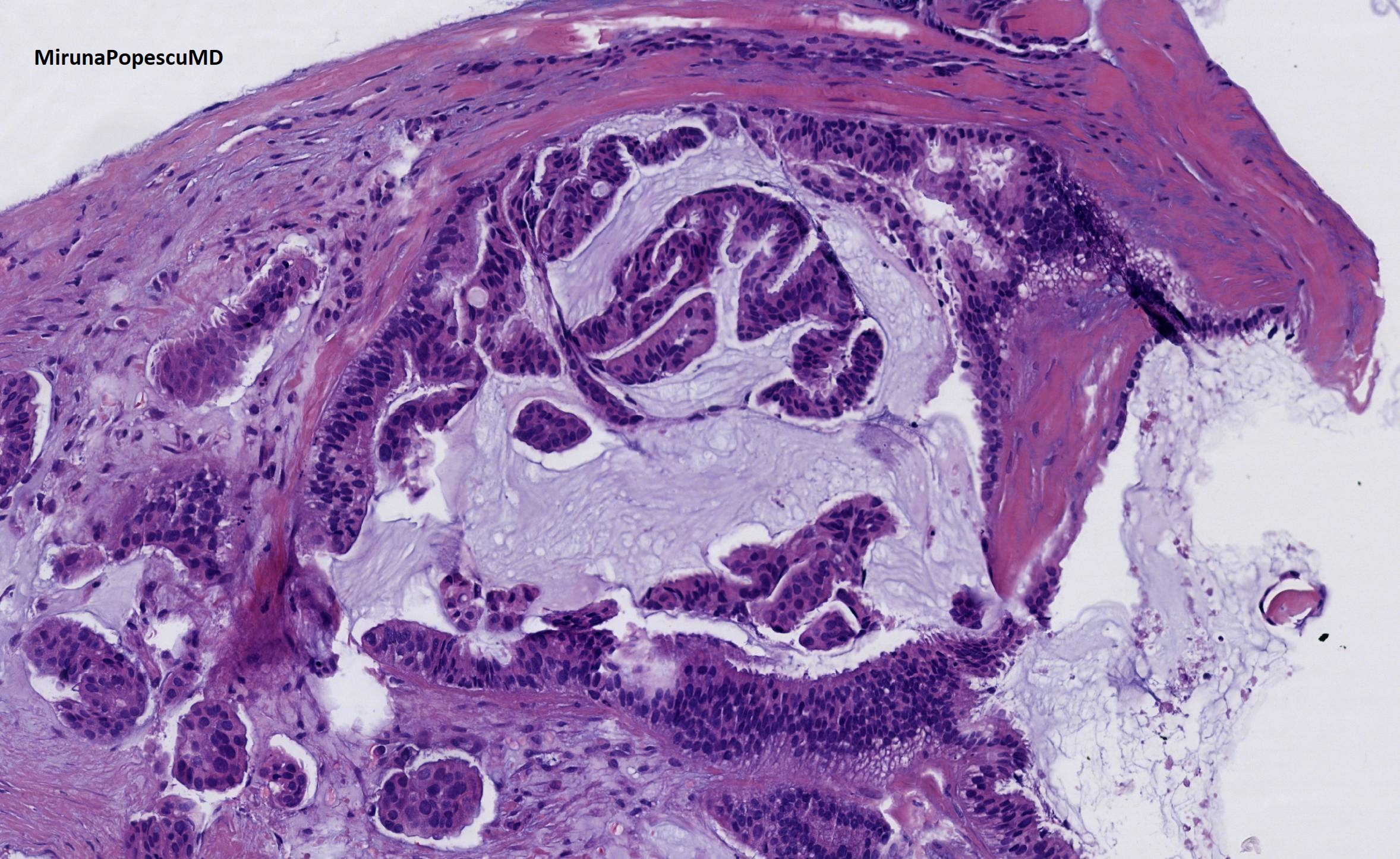 What Is The Survival Rate Of Mucinous Ovarian Cancer